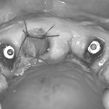 Implantologia Post-estrattiva e Socket Preservation